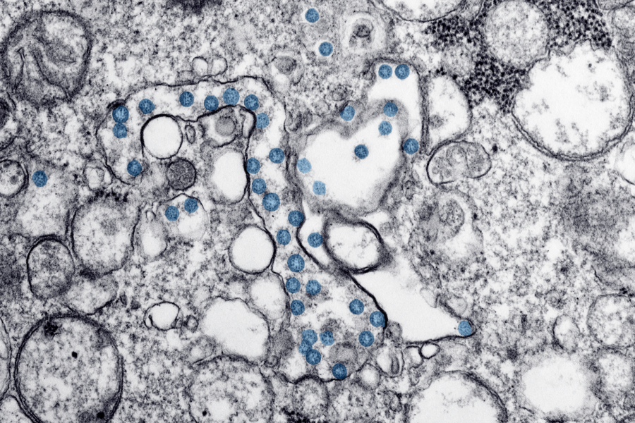 This image from the CDC features a transmission electron microscopic image from first COVID-19 patient.