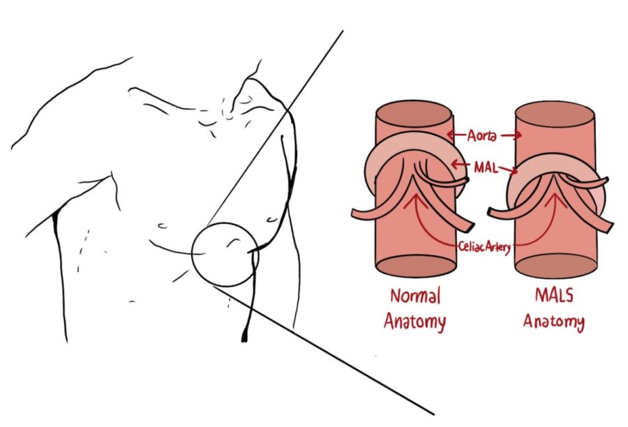 A diagram that shows where and how MALS affects someone's celiac artery.